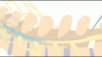 Animation of Spinal Cord Stimulator Implant Procedure
