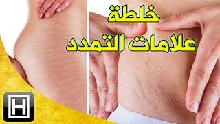 علاج تشققات الجلد البيضاء والخطوط البيضاء بالجسم وأثار الحمل على البشرة بخلطة مضمونة