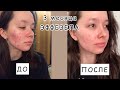 Эффезел. 3 месяца лечения акне