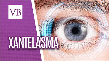Onde tirar xantelasma?