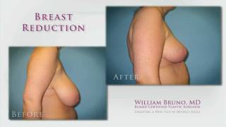 Beverly Hills Breast Reduction | Dr. William Bruno