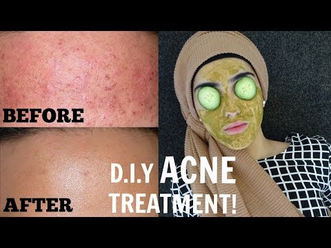 How To Get Rid of ACNE Naturally At Home | Treat Pimples Instantly! ~ Immy