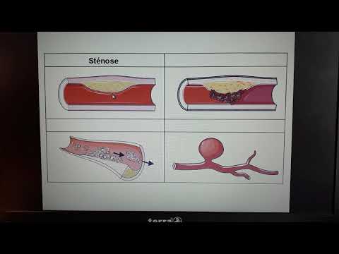 Vidéo: Minéraux Pour Le Traitement De L'athérosclérose: Iode, Sélénium, Zinc, Cuivre