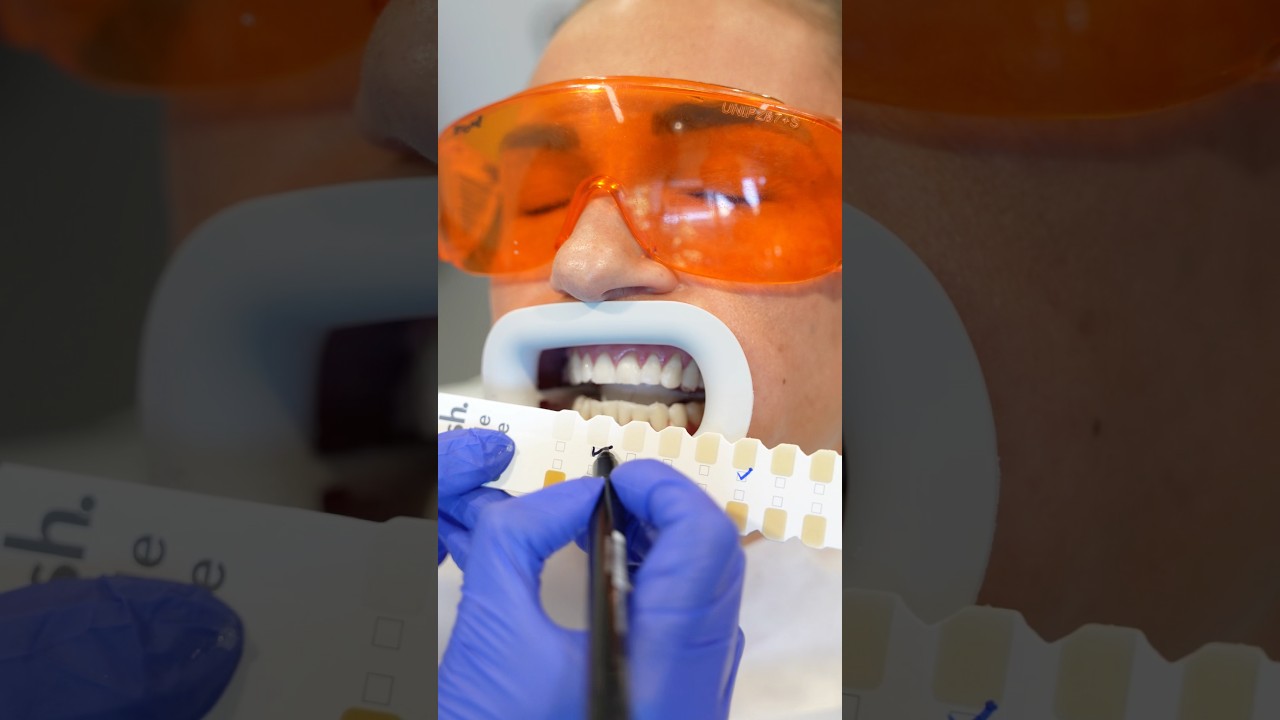 Professional Teeth Whitening Results You Can See Immediately