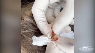 Extracting a Pilar Cyst (Pilar Cysts Can Haunt Your Scalp) | CONTOUR DERMATOLOGY