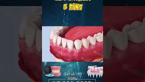 [3D] CẮM IMPLANT 3 RĂNG || Nha Khoa Quốc Tế Athena