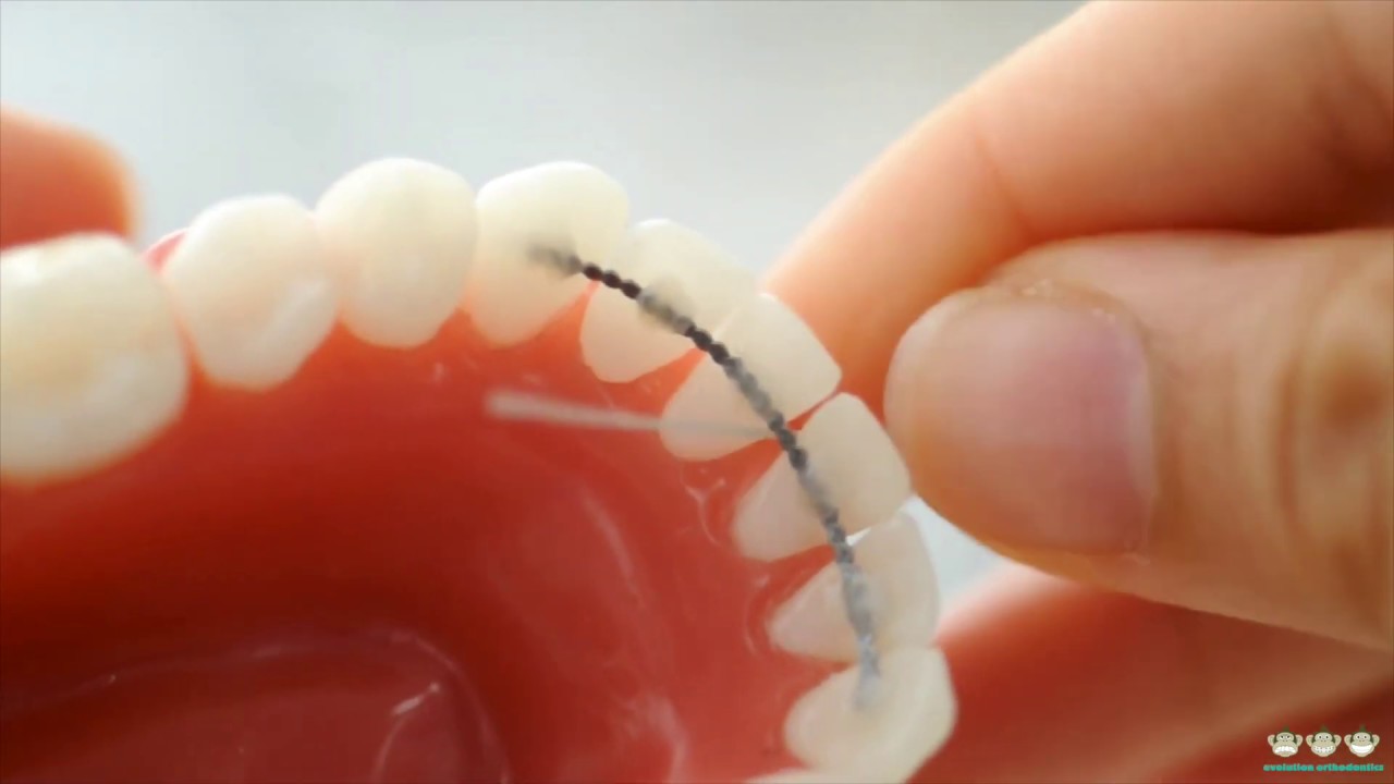 How to use Superfloss with fixed braces. 