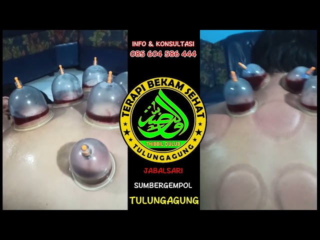 Terapi Bekam Tulungagung, Bekam Sumbergempol, Apapun Sakitnya Bekam Solusinya #085604586444 class=