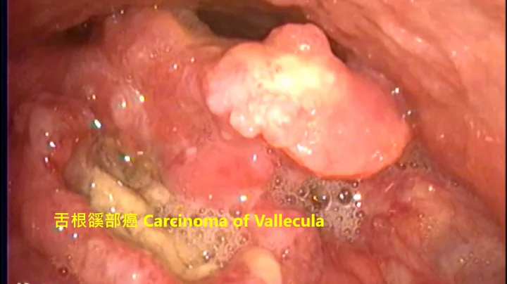 口咽癌、上喉癌、聲帶結節 Carcinomas of oropharynx vallecula & larynx epiglottis, vocal nodules - 天天要聞