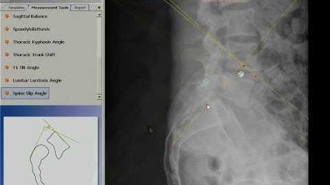 TraumaCad - Spine Slip Angle