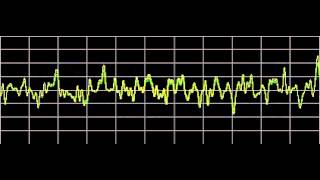 Cluster Headaches  Rife Frequencies