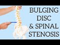 Best Exercise for Sciatica from Bulging Disc In Addition to Spinal Stenosis or Spondylolisthesis