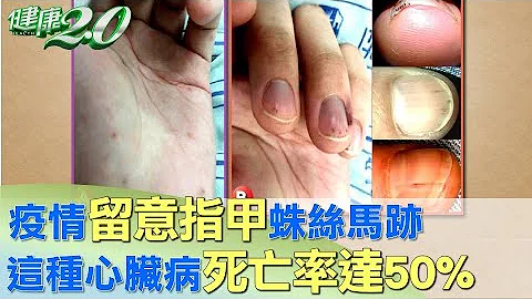 疫情期間留意"指甲"蛛絲馬跡 這種"心臟病"死亡率達"50%" 健康2.0 - 天天要聞
