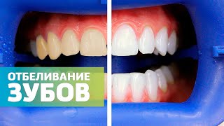 Как сделать зубы белыми за 45 минут | Отбеливание зубов системой ZOOM 4 без боли | Дентал ТВ