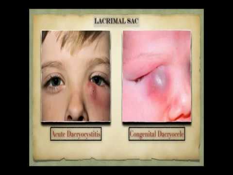 Video: Epiphora (udarea Ochilor): Cauze și Tratament