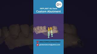 Case of the day 💫 IMPLANT Ab Dent Custom Abutment |Global Design Consultancy | exocad | #smiledesign
