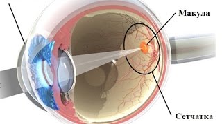 Разрывы сетчатки глаза- причины и лечение