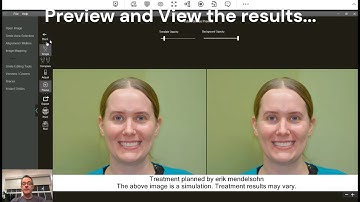 Porcelain Veneer AI Smile Simulation : Egg Harbor Twp Dentist: Serenity Smile Designs