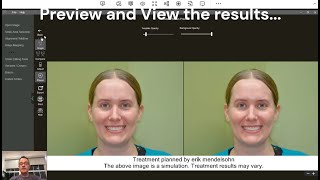 Porcelain Veneer AI Smile Simulation : Egg Harbor Twp Dentist: Serenity Smile Designs