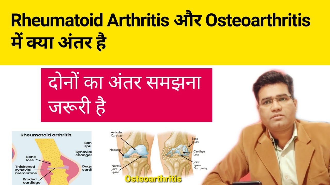What are The Difference Between Rheumatoid Arthritis and Osteoarthritis