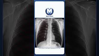 3 Steps to Assessing the Quality of a Chest X Ray #medicine 3 Steps to Assessing the Quality of a Chest X Ray #medicine