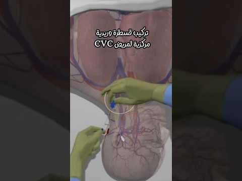 تركيب سنتر لاين لمريض بالرعاية المركزة