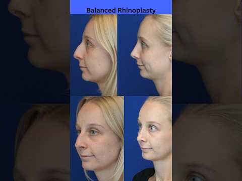 Video thumbnail: Prominent Big Nose | Dorsal Hump | Balanced Rhinoplasy! · Ali Sajjadian