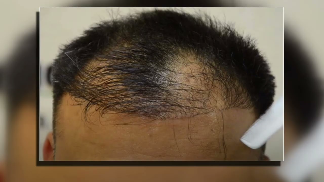 Başarısız Saç ekimi ! 