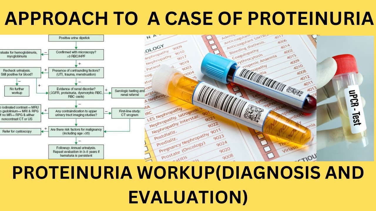APPROACH TO A CASE OF PROTEINURIA.DIAGNOSIS AND EVALUATION OF