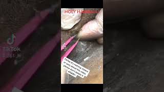 Holy Hairball! Ingrown Hair! #viralvideo #fyp #tiktok #youtube #viral #ingrownhair #pimple #cyst