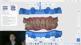Modelos Impresos | Tutorial MEDIT, software gratuito de diseño dental