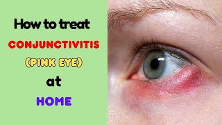 Conjunctivitis (pink eye) home remedies, natural remedies, home treatment, natural treatment