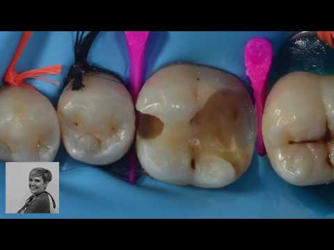 تصویری: ترمیم دندان بدون رنگ چگونه انجام می شود؟
