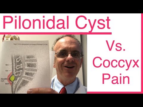 Video: Pilonidal Cista: Simptomi, Cēloņi, ārstēšana, Coccyx Foto