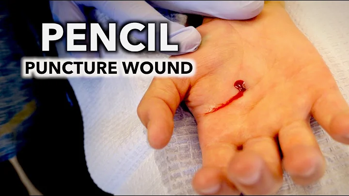 HE STABBED HIS HAND WITH A PENCIL! (puncture wound...