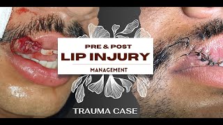 LIP INJURY | LIP TRAUMA MANAGEMENT | TRAUMATIC LIP INJURY | LIP LACERATION| UPPER LIP INJURY