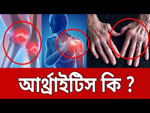 ভিডিও: আর্থরাইটিক জয়েন্টগুলি কি ফাটল?