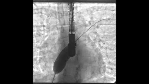 Stop-flow Technique, 15mm+ ASD