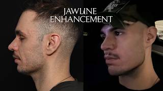 Male Jawline Enhancement With Custom PEEK Implants Before &amp; After