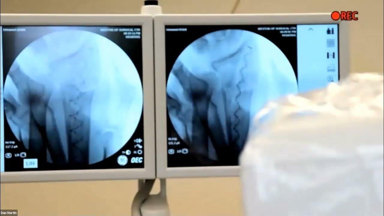 IlluminOss for Distal Radius Fractures Dr. David Shenassa YouTube