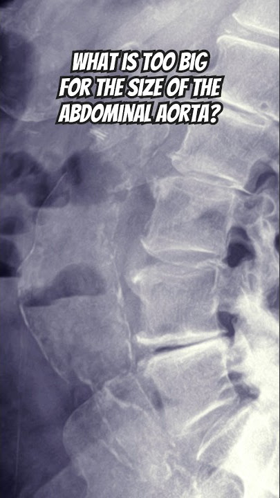 🤔HOW BIG is TOO BIG🤔for the Abdominal Aorta? 📏#radiology #chiropractic #doctor