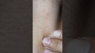 #ingrownhair #oddlysatisfying #massage #therapy #shorts #video
