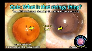 CataractCoach™2168: Cataract Quiz: What is that stringy thing in the vitreous?