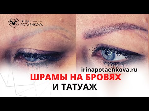 Татуаж шрамов на бровях