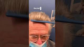 Hairline lowering #hairlinelowering #hairlinerestoration #hairtransplant #fuehairrestoration #fue