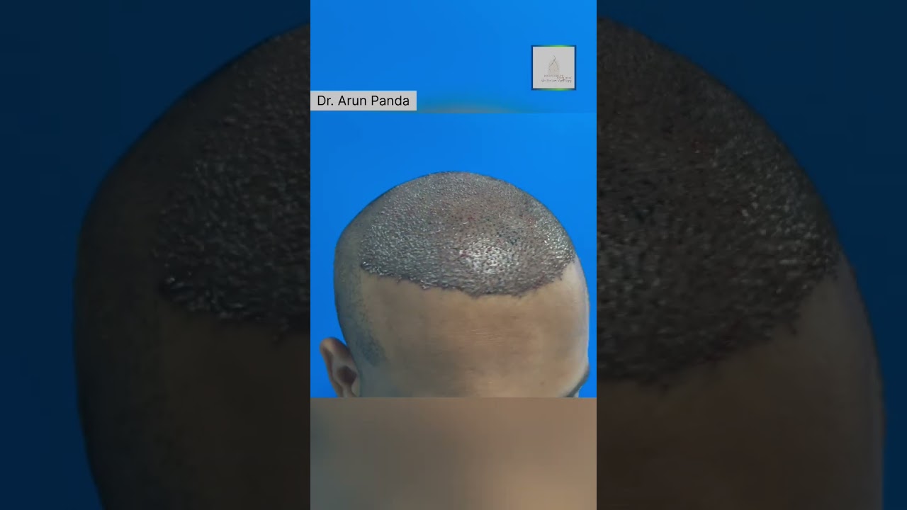 High Density hair transplant in Navi Mumbai 