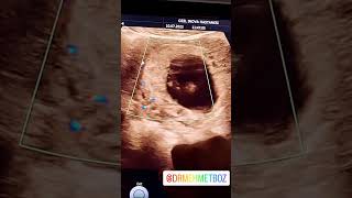 Bebek Kalp Atişlari Yok. 9. Hafta Gebelik. Renkli Doppler Ultrason. Dr Mehmet Boz 2023