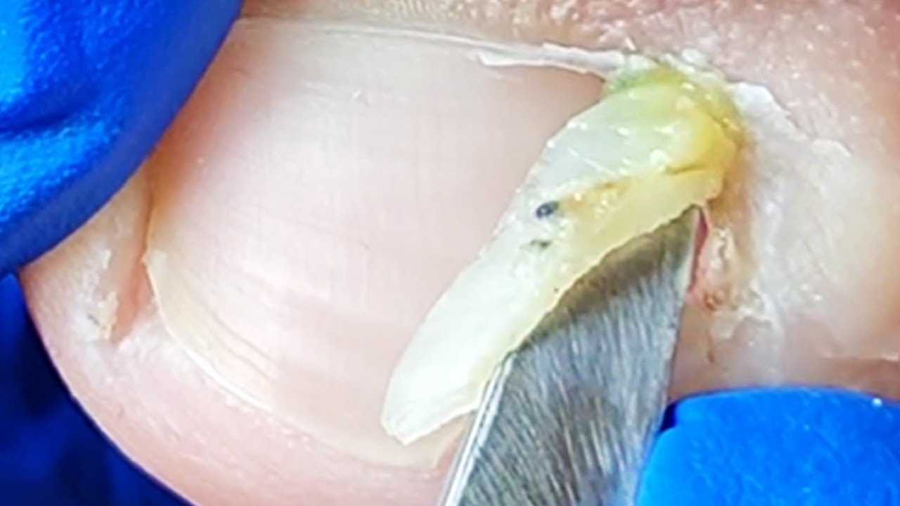 Pedicure Tutorial The Complete Trimming Process for Ingrown Toenails