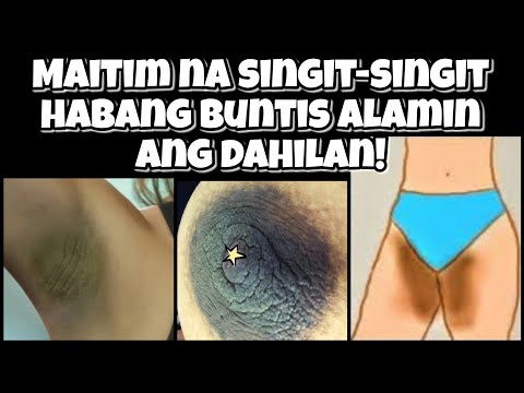 Video: Pigmentation Pagkatapos Ng Pagbubuntis - Kung Paano Mapupuksa?