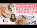 How to get rid and prevent toenail fungus?